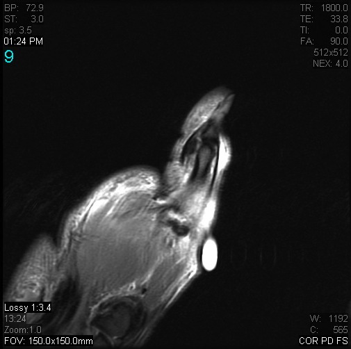 Figure 5 for case Stener lesion